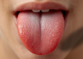 how to remove white tongue