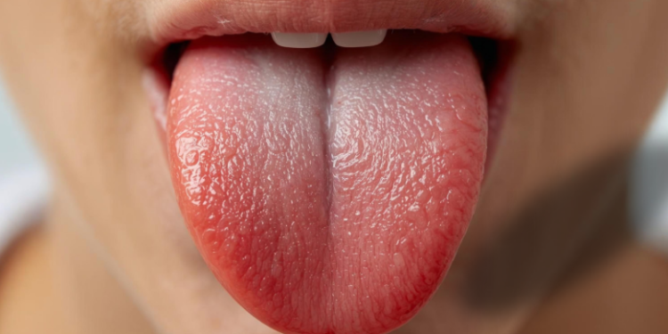 how to remove white tongue
